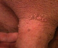 Bumps on pubic area men