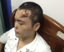 Chinese Man With Nose On Forehead