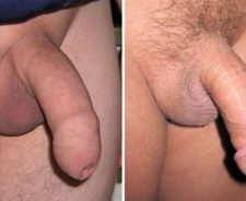 Circumcised Vs Uncircumcised Penis
